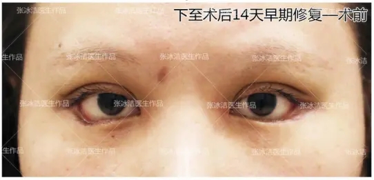 下睑下至修复案例
