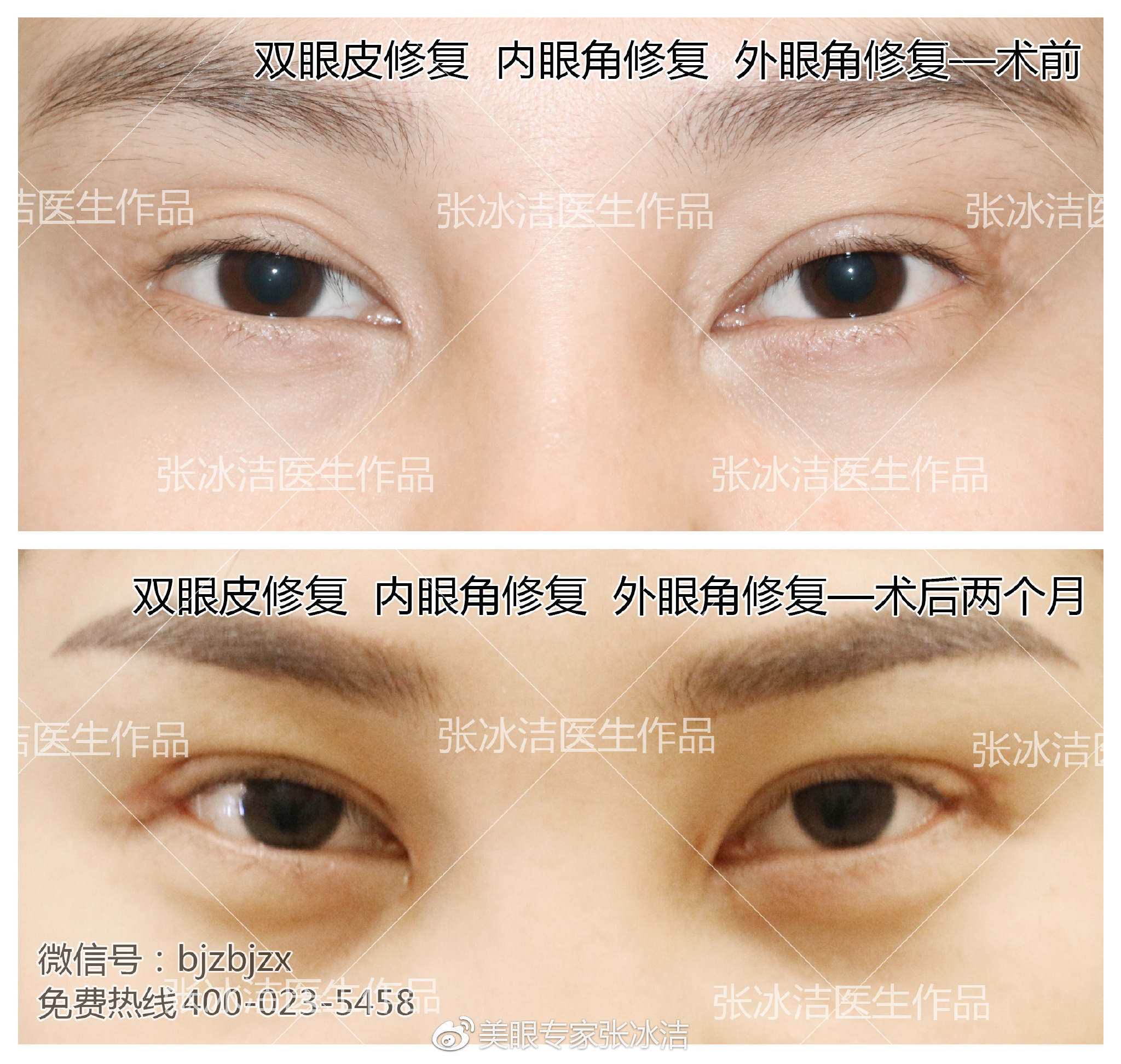 内眼角括号疤痕修复+外眼角疤痕粘连修复