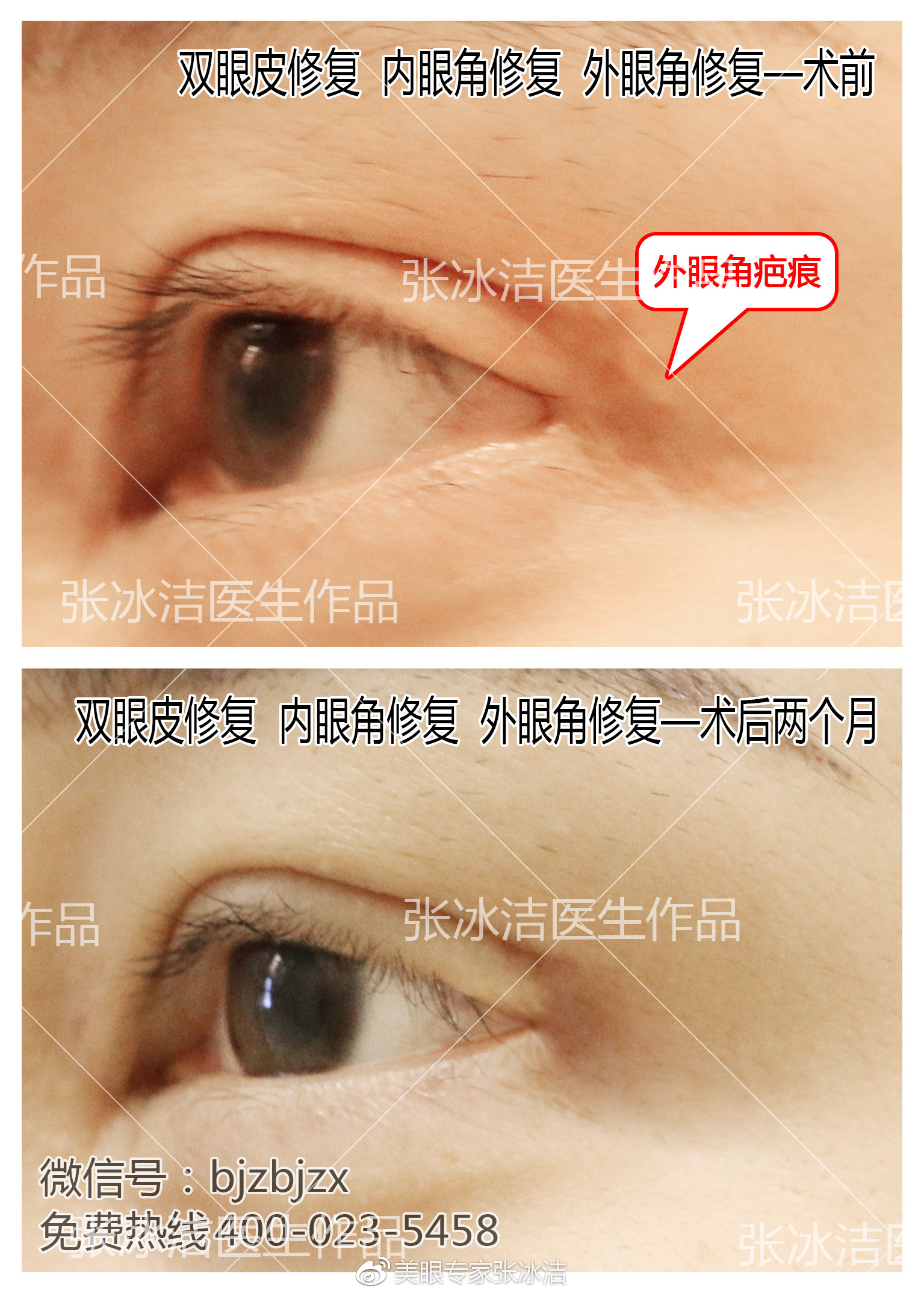 外眼角疤痕粘连修复