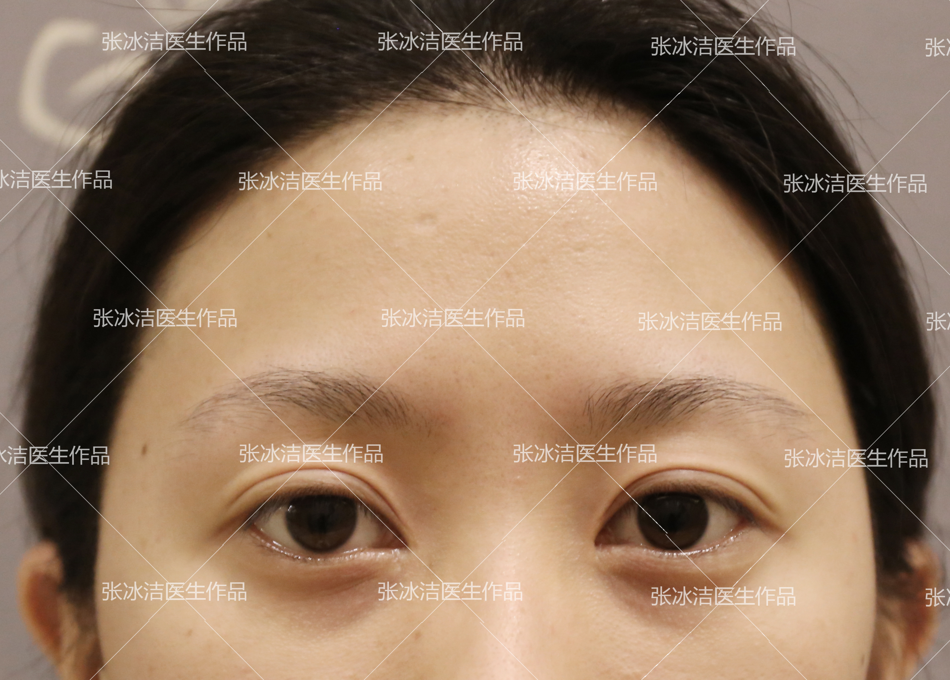 内眼角开的过大，露红收眼角修复