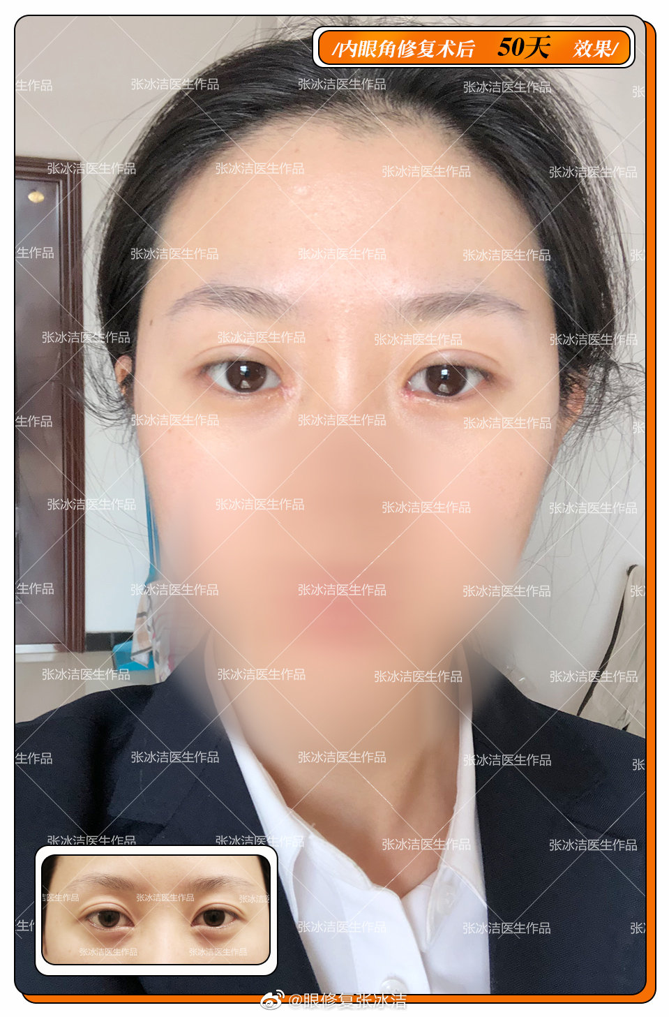 内眼角开的过大，露红，疤痕，下沉“收眼角”修复50天