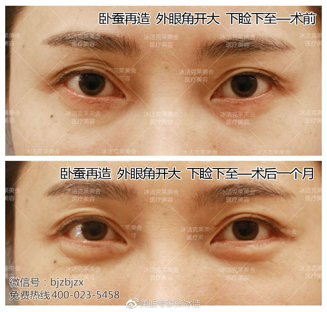 下睑下至+自体真皮卧蚕案例照片
