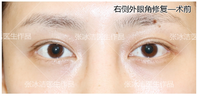 外眼角修复