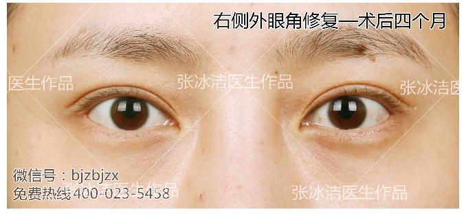 外眼角修复