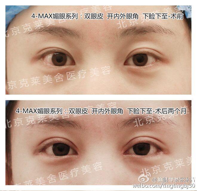 下睑下至案例照片