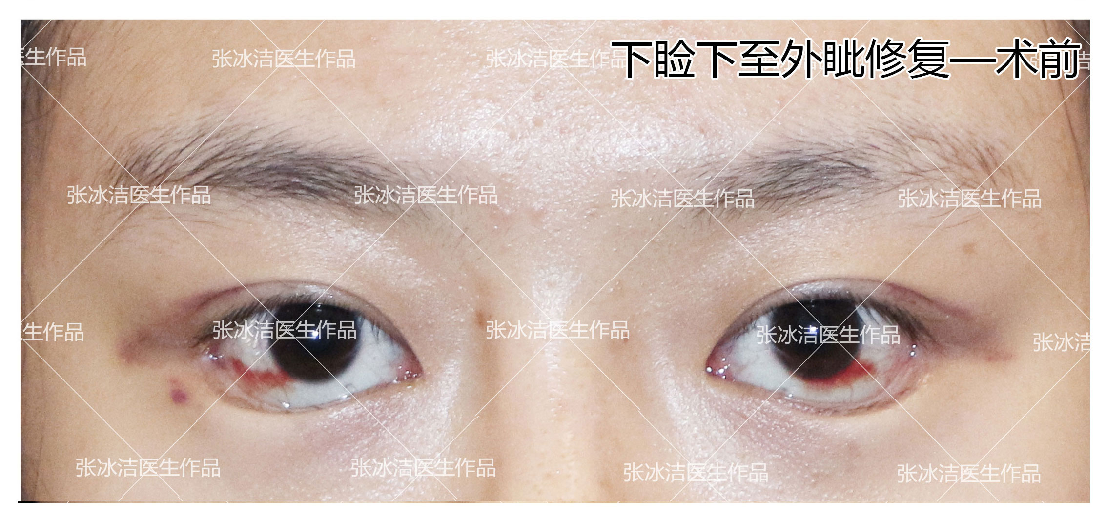 下睑下至下睑退缩凹陷，三白眼修复术前照片