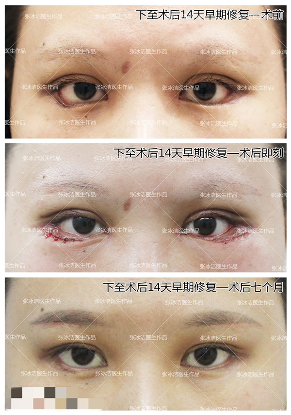下睑下至下睑退缩凹陷，外翻露红修复案例